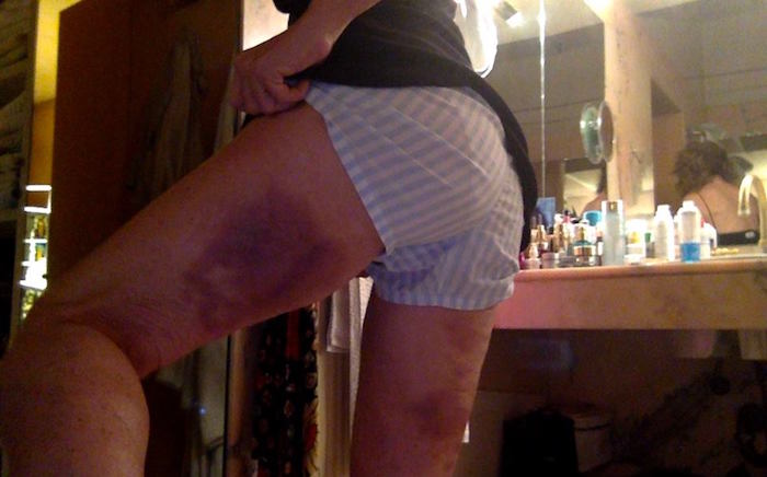 Giuliana De Sio piena di lividi. Gli effetti collaterali di Ballando con le Stelle mostrati da Milly Carlucci