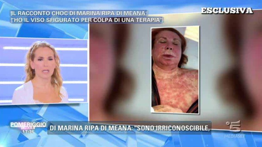 Marina Ripa Di Meana sfigurata da una reazione allergica. Si mostra a Pomeriggio Cinque e Mattino Cinque
