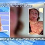 Marina Ripa di Meana sfigurata - shock anafilattico